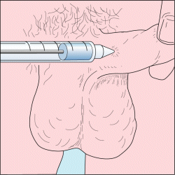 An intracavernosal injection of alprostadil